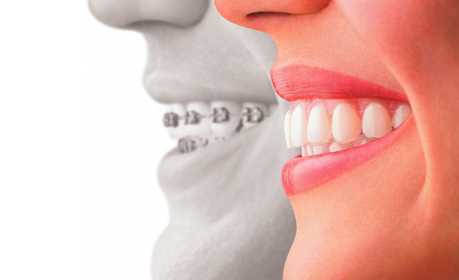 Featured image for “How Braces Improve Oral Health”