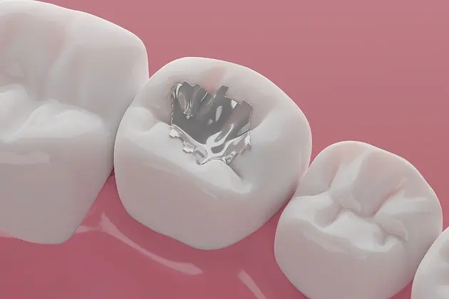 Dental fillings in Eugene