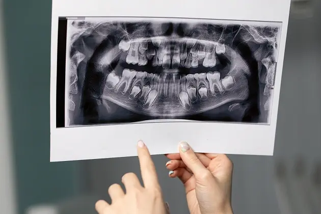 Dental X-Rays