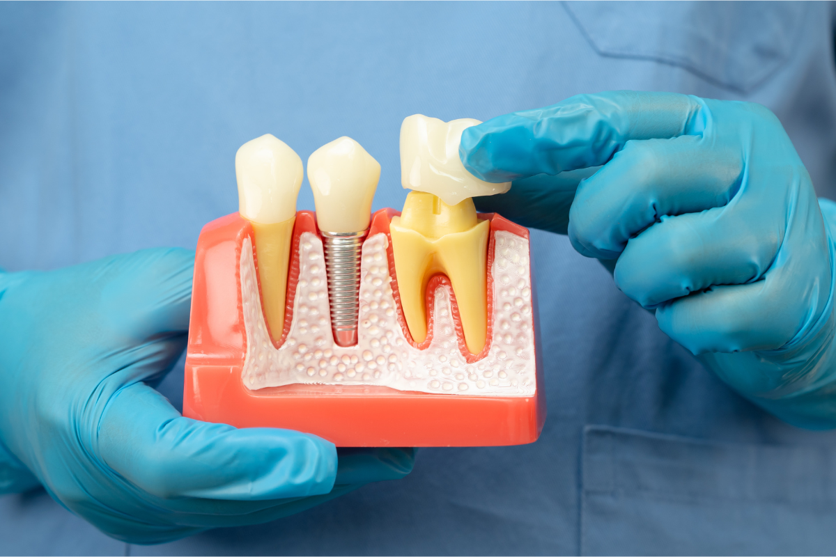 Featured image for “What Are the Signs You Need a Dental Crown? 9 Warning Signals to Watch For”