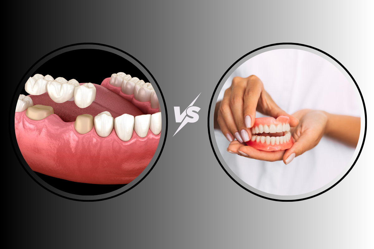 Featured image for “Dental Implants vs Bridges: What Eugene Patients Should Know Before Choosing a Tooth Replacement”