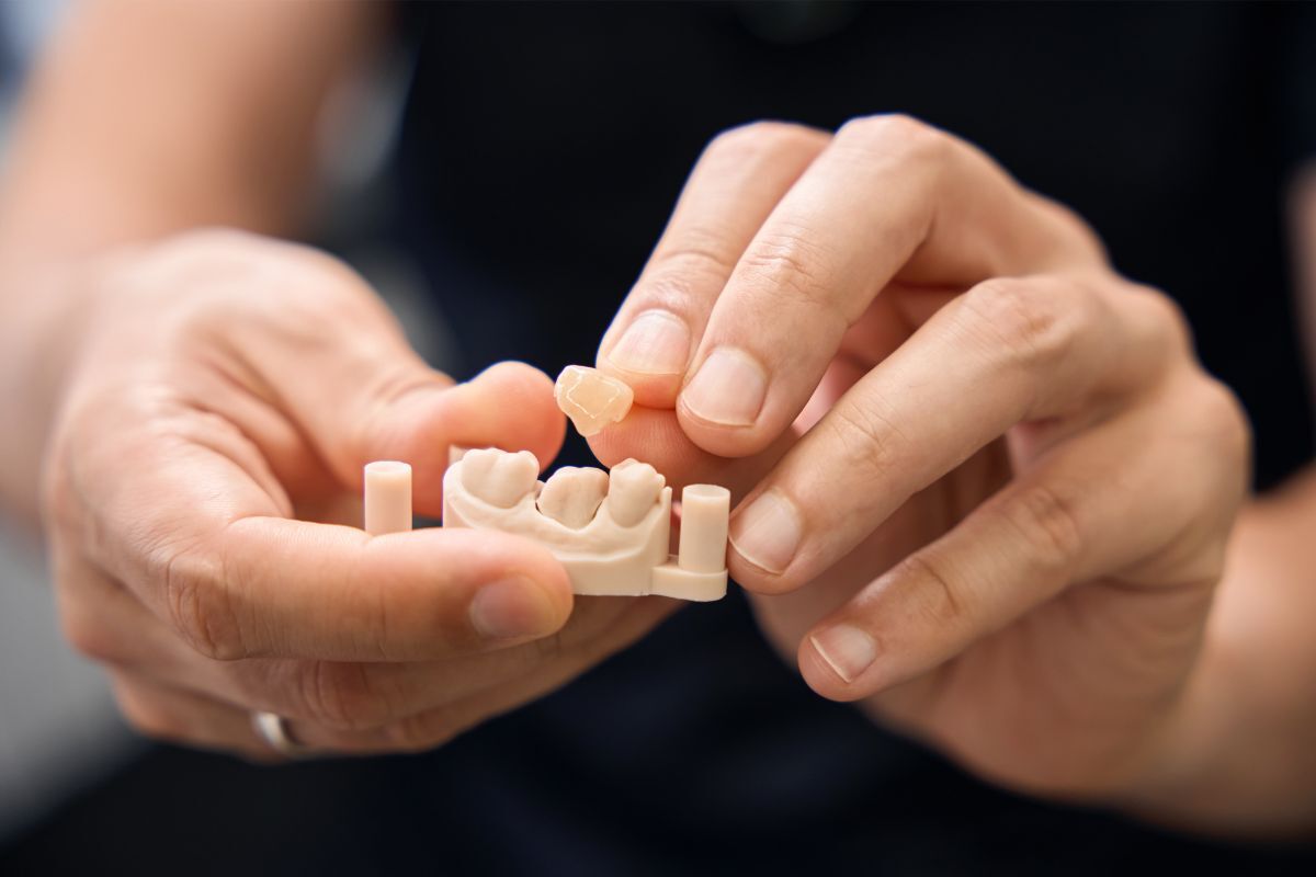 Featured image for “How Long Do Dental Crowns and Bridges Really Last?”