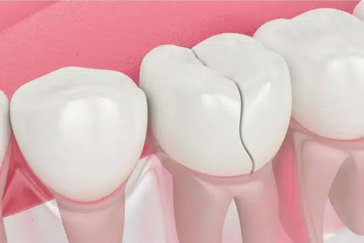 Featured image for “Can a Cracked Tooth Be Saved? What Every Eugene Patient Should Know Before It’s Too Late”